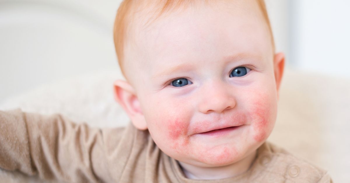 Crianças com Dermatite Atópica e Problemas de Sono