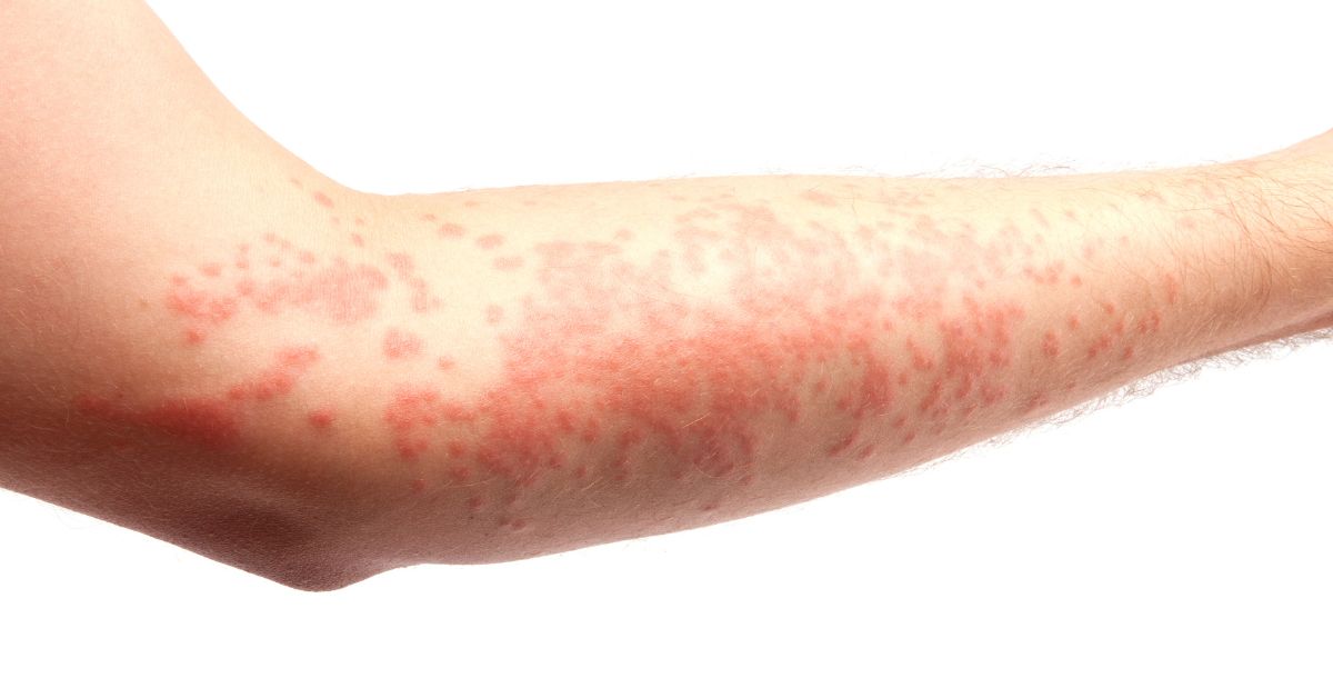 Alergia na Pele: Causas, Sintomas e Tratamento